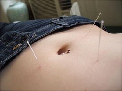 Acupuntura