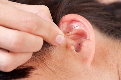 Auriculoterapia